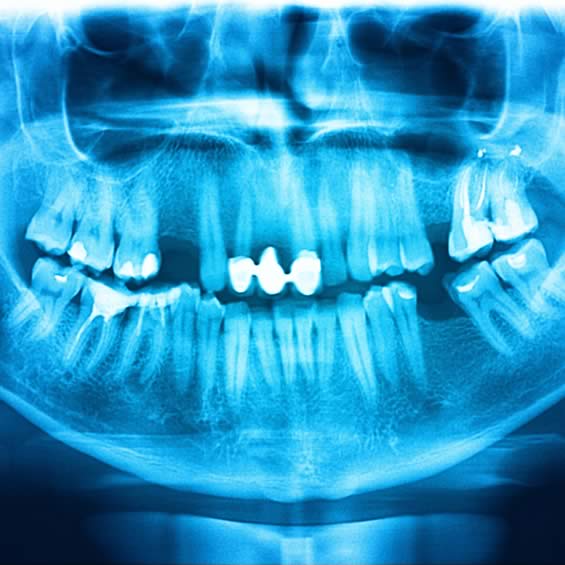 X-Ray of teeth