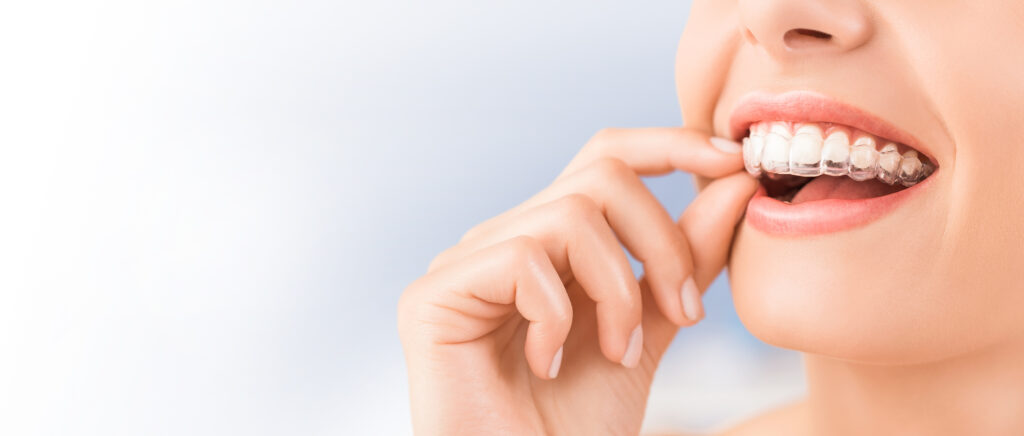 Close up of woman holding clear aligners with tooth whitening gel and removing them from teeth